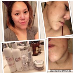 Abby Skin Clinic - I LOVE USING ABBY SKIN CARE PRODUCTS BYE BYE TO MY ACNE SCARS