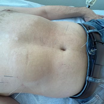 Chen's Chinese Medicine - Acupuncture for my Stomach disorders - Acupuncture Near Me - Camarillo, California Chen's Chinese Medicine - Acupuncture for my Stomach disorders - Acupuncture Near Me - Camarillo, California