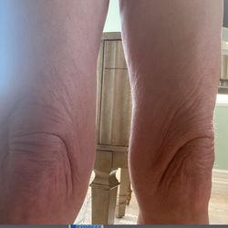 L.A. Vinas, M.D. Plastic Surgery, Med Spa & Skin Care Centers - Before Thigh lift