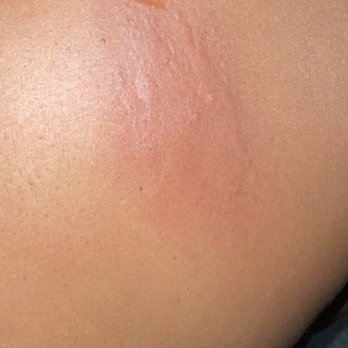 Clark Salon & Spa - ONE OF THE RASHES ON MY BODY AS A RESULT OF THEIR NEGLIGENCE OF NOT CLEANING THEIR SPA/SALON. - Hair Salons Near Me - Canton, Georgia Clark Salon & Spa - ONE OF THE RASHES ON MY BODY AS A RESULT OF THEIR NEGLIGENCE OF NOT CLEANING THEIR SPA/SALON. - Hair Salons Near Me - Canton, Georgia