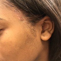 Splendore Beauty Center Inc - Burned my skin