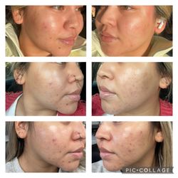 Skin By Britney - Top - Bottom: current skin (2/26) to beginning of Dec 24'