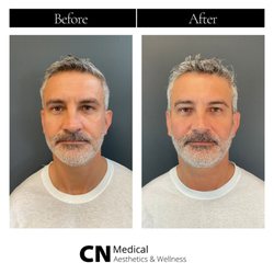 CN Medical Aesthetics & Wellness - 2 Syringes of Radiesse.