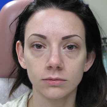 Aesthetic Laser Center - Before. Tear-trough, midface deflation. - Medical Spas Near Me - Lake Oswego, Oregon Aesthetic Laser Center - Before. Tear-trough, midface deflation. - Medical Spas Near Me - Lake Oswego, Oregon