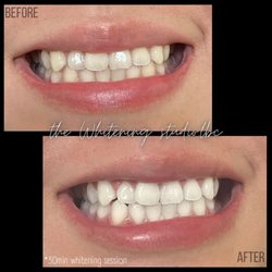 30min Teeth Whitening Session