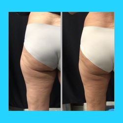 Contouring By Kate - Post Coolsculpting to the outer thigh