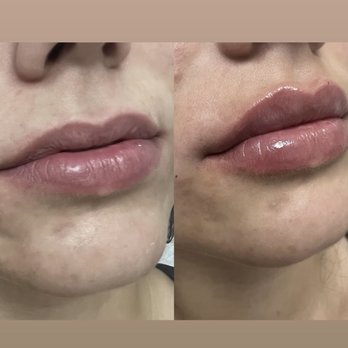 Boone Dermatology Clinic - Erin Batemen Swedish lip filler technique - Dermatologists Near Me - Boone, North Carolina Boone Dermatology Clinic - Erin Batemen Swedish lip filler technique - Dermatologists Near Me - Boone, North Carolina