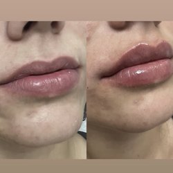 Erin Batemen Swedish lip filler technique