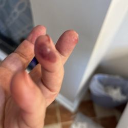 Pearl Nails & Spa - Finger nail infection