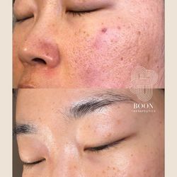 Two sessions of microneedling with PDGF.