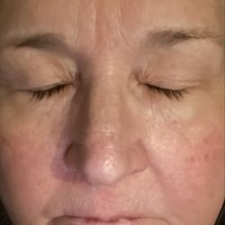 Asky Nails Spa - 12 hours later notice eye puffiness gone. Impurities coming to surface that will clear up quickly. Rosacea will calm