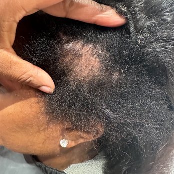 Salon DLM - Bald spots after microlinks - Makeup Artists Near Me - Temecula, California Salon DLM - Bald spots after microlinks - Makeup Artists Near Me - Temecula, California