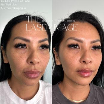 The Laser Image - EZ GEL Prfm, Refilled Lips and Microneedling. 310-543-9073 - Skin Care Near Me - Redondo Beach, California The Laser Image - EZ GEL Prfm, Refilled Lips and Microneedling. 310-543-9073 - Skin Care Near Me - Redondo Beach, California