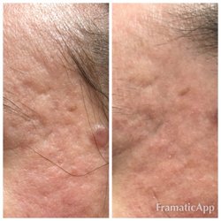Revitalize A Skin Studio - After two microneedling treatments, month after last treatment. Performed by our practice.