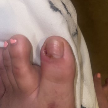 Royal Nails & Spa - Infected toe nail - Nail Salons Near Me - Bakersfield, California