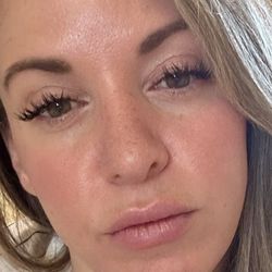 Sunrise Dermatology - 2 days before microneedling with Sarah