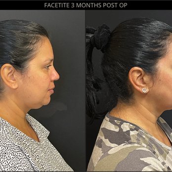SkinMD - 3 months POST OP FACETITE - Laser Hair Removal Near Me - Boston, Massachusetts SkinMD - 3 months POST OP FACETITE - Laser Hair Removal Near Me - Boston, Massachusetts