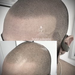 Scalp Los Angeles - SMP Touch-up