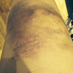 My leg injury from riding at this establishment on a trail ride.