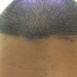 Razor burn I got from this shop. Don't come here.
