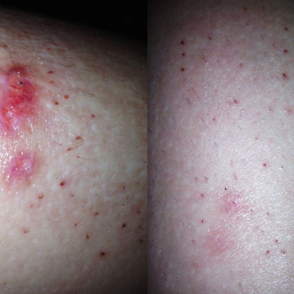 Abracadabra Electrolysis - PLEASE CONSIDER MY REVIEW after I got 2nd degree burn at Abracadabra electrolysis with infection! - Hair Removal Near Me - New York, New York