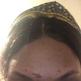 This is what happen to my skin after getting my eyebrows waxed. Approximately 1 hour. This is what happen to my skin after getting my eyebrows waxed. Approximately 1 hour.