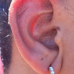 Indentation on Scapha 10 minutes after piercing removal. Indentation on Scapha 10 minutes after piercing removal.