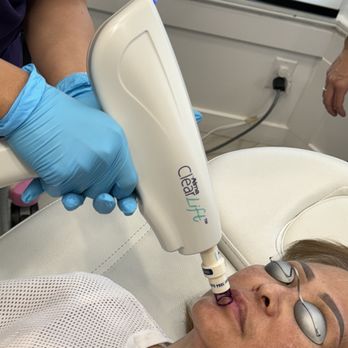 Robert Tracy, MD - Alma ClearLift laser toning for lip plumping- a natural alternative to fillers! - Medical Spas Near Me - Fullerton, California Robert Tracy, MD - Alma ClearLift laser toning for lip plumping- a natural alternative to fillers! - Medical Spas Near Me - Fullerton, California