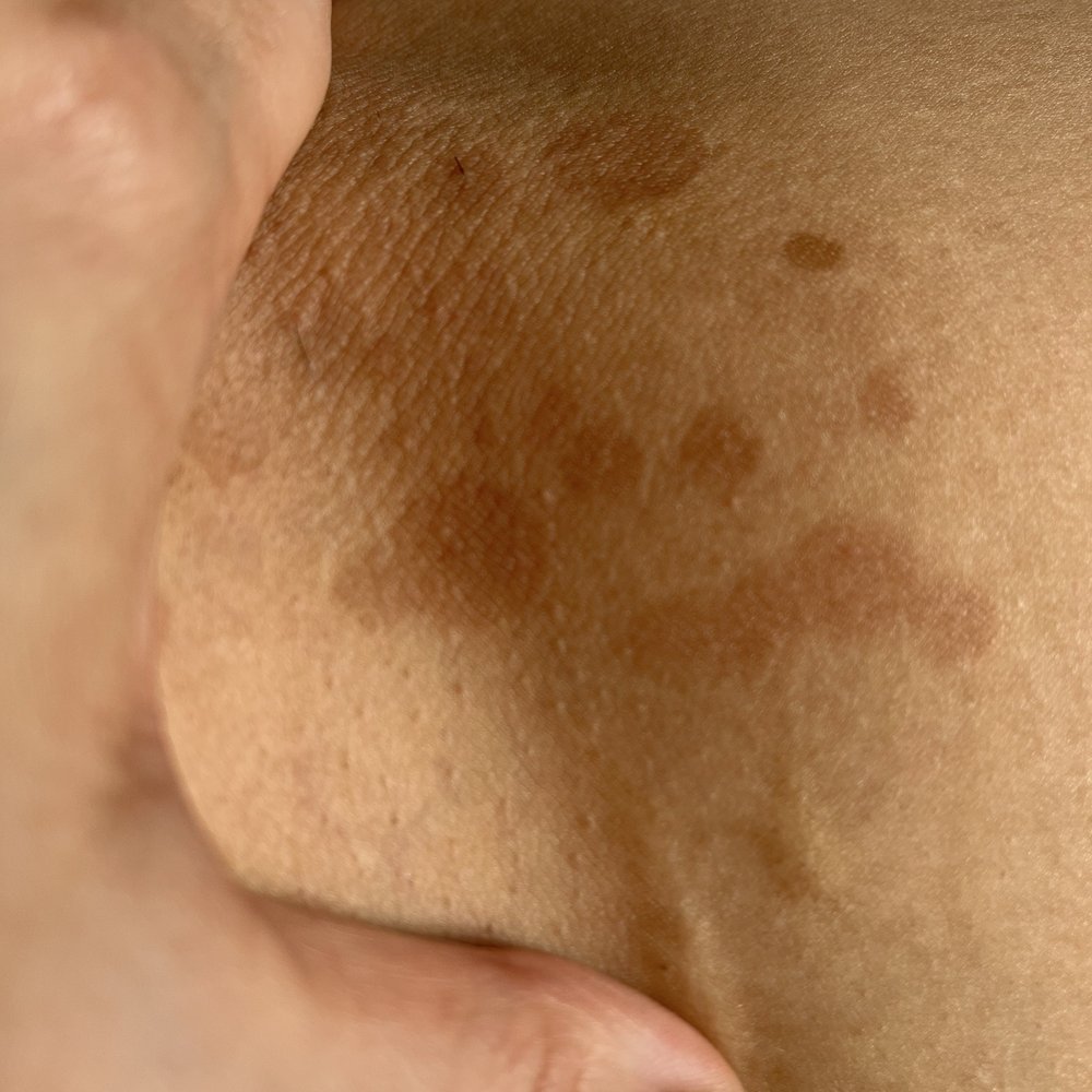 Bared Monkey Laser Spa - Scarring from laser hair removal treatment. - Laser Hair Removal Near Me - New York, New York Bared Monkey Laser Spa - Scarring from laser hair removal treatment. - Laser Hair Removal Near Me - New York, New York