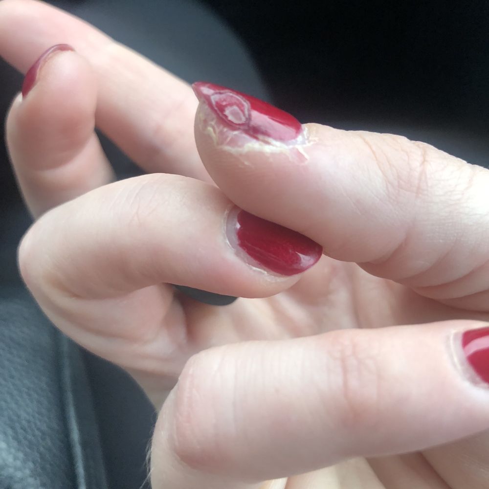 This is the transition of my nails lifting from the nail beds This is the transition of my nails lifting from the nail beds
