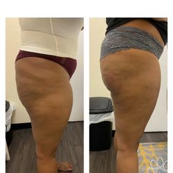 Get It Right Body Scultpting By Tee - Butt Lift (non-invasive)