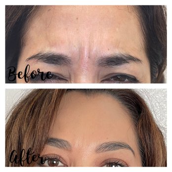 Glo Aesthetics - Treat frown lines with Botox - Medical Spas Near Me - El Monte, California Glo Aesthetics - Treat frown lines with Botox - Medical Spas Near Me - El Monte, California