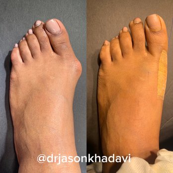Jason Khadavi, DPM - A beautiful bunion procedure for our patient. She will be back to activities in no time. - Podiatrists Near Me - Beverly Hills, California