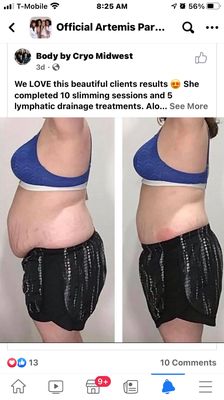 Cryo Skin Before & Afters - Cryo Skin is a freezing of FAT. It is a permanent procedure and last for 2 to 3 years. No pain, no down time, no excuses. Get on the phone and make your free consultation appointment now! 661-294-0433 or follow us on Instagram @dermaldynamics_ and Facebook https://www.facebook.com/DermalDynamics Cryo Skin Before & Afters - Cryo Skin is a freezing of FAT. It is a permanent procedure and last for 2 to 3 years. No pain, no down time, no excuses. Get on the phone and make your free consultation appointment now! 661-294-0433 or follow us on Instagram @dermaldynamics_ and Facebook https://www.facebook.com/DermalDynamics