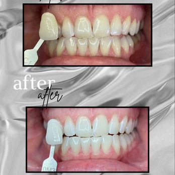 Harvard Place Dental - Professional In-Office Whitening!
Quick, Painless and Beautiful results in under an hour! - Cosmetic Dentists Near Me - Irvine, California Harvard Place Dental - Professional In-Office Whitening!
Quick, Painless and Beautiful results in under an hour! - Cosmetic Dentists Near Me - Irvine, California