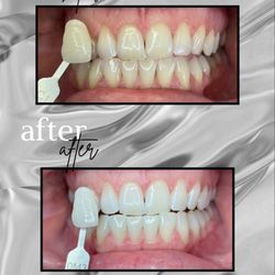 Harvard Place Dental - Professional In-Office Whitening!

Quick, Painless and Beautiful results in under an hour!