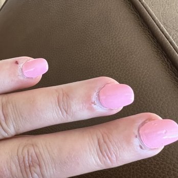 Lily Nails - if you want longer then this length--- $5 more!!! (Hands healing after getting a full set of acrylic nails at lily nails SJC.) - Nail Salons Near Me - San Juan Capistrano, California Lily Nails - if you want longer then this length--- $5 more!!! (Hands healing after getting a full set of acrylic nails at lily nails SJC.) - Nail Salons Near Me - San Juan Capistrano, California