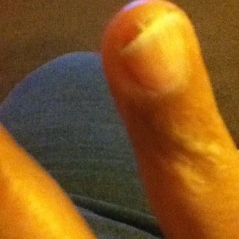 Nail Time 2 - Nail infection I received from this place. This is one of 5 nails lifting from the nail bed and swollen and sore. - Nail Salons Near Me - North Highlands, California