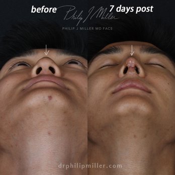 Gotham Plastic Surgery - Rhinoplasty, 7 days post. - Cosmetic Surgeons Near Me - New York, New York Gotham Plastic Surgery - Rhinoplasty, 7 days post. - Cosmetic Surgeons Near Me - New York, New York