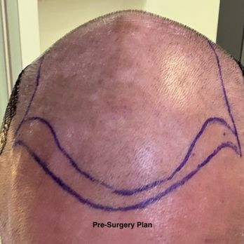 TJ Hair System - Hair Loss Centers Near Me - Tijuana, BCN TJ Hair System - Hair Loss Centers Near Me - Tijuana, BCN