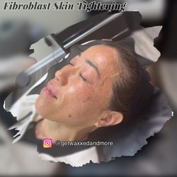 Sage and Silk Skin Studio - Full face lift - fibroblast skin tightening