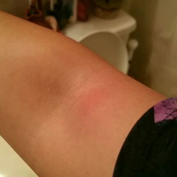 Quality Inn Greenville Near University - Huge bed bug bite on my arm. Luckily they didn't follow me home. - Hotels Near Me - Greenville, North Carolina Quality Inn Greenville Near University - Huge bed bug bite on my arm. Luckily they didn't follow me home. - Hotels Near Me - Greenville, North Carolina