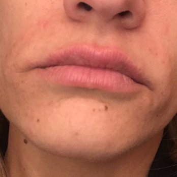 San Diego Body Contouring - 4 days after dissolving filler - Cosmetic Surgeons Near Me - San Diego, California San Diego Body Contouring - 4 days after dissolving filler - Cosmetic Surgeons Near Me - San Diego, California