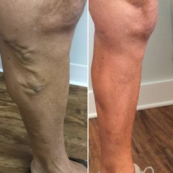 Ageless Rejuvenation Center - Varicose and Spider Vein Treatments. Your legs will look and feel better.