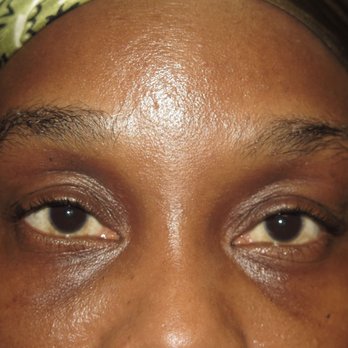 Lorri Cobbins, MD - Before without flash - Cosmetic Surgeons Near Me - Chicago, Illinois