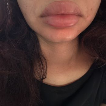 NakedMD - How do you go from my original picture to this? They look insane. - Medical Spas Near Me - Torrance, California NakedMD - How do you go from my original picture to this? They look insane. - Medical Spas Near Me - Torrance, California