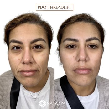 Naya Wellness - PDO thread lift by Carolyn - Medical Spas Near Me - Chatsworth, California Naya Wellness - PDO thread lift by Carolyn - Medical Spas Near Me - Chatsworth, California
