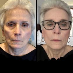 Renu Aesthetics & Wellness - Focused on the lower half of the face, the nasolabial lines, bringing up the corners of the mouth, and topping it with natural lips