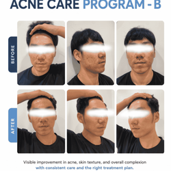 Acne Care Program - B (Before & After)