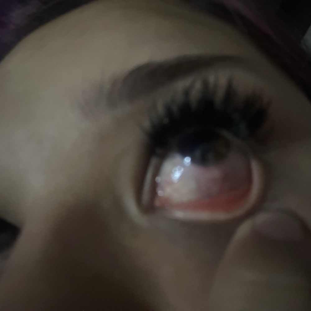 OMG Head Spa & Lash - Bruised sclera (right side) - Eyelash Service Near Me - Cypress, Texas OMG Head Spa & Lash - Bruised sclera (right side) - Eyelash Service Near Me - Cypress, Texas